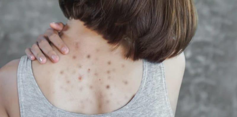 7 Cara Hilangkan Jerawat Badan Dengan Cepat, Gunakan Bahan Dapur Sahaja!