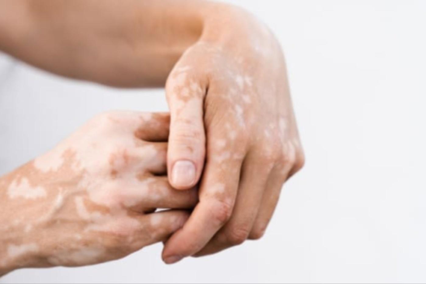 Ada Tompok Putih Pada Badan? Ini Vitiligo Atau Lebih Dikenali Sebagai Penyakit Sopak!