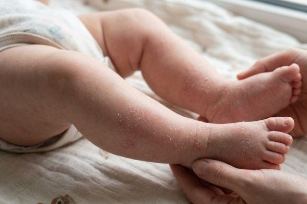 tanda penyakit kawasaki pada anak