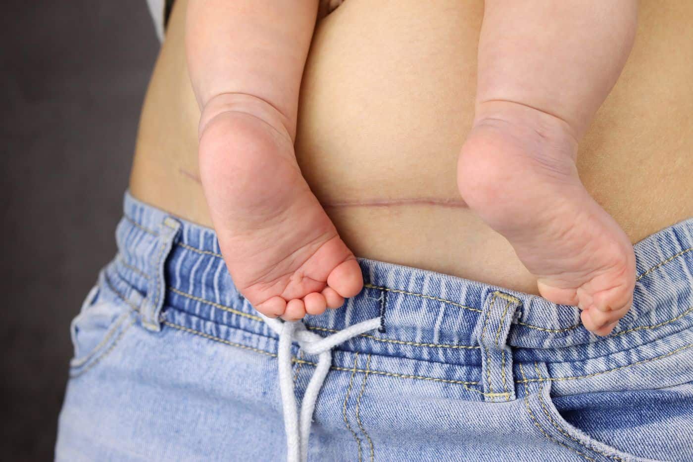 Nak Kempiskan Perut Lepas Czer? Ini 4 Cara BERKESAN, Mama Mesti Cuba!