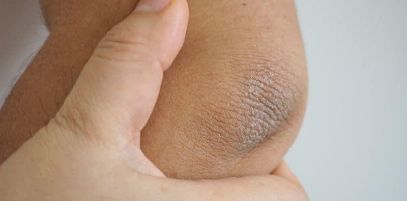 Siku Hitam, Gelap & Berkerak? Cuba 5 Cara Ini, Barulah Tak Seram Tengok Siku Sendiri!