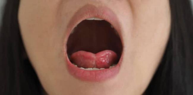 5 Punca Mulut Anda Berdarah Secara Tiba-Tiba Selain Tergigit Lidah Sendiri!