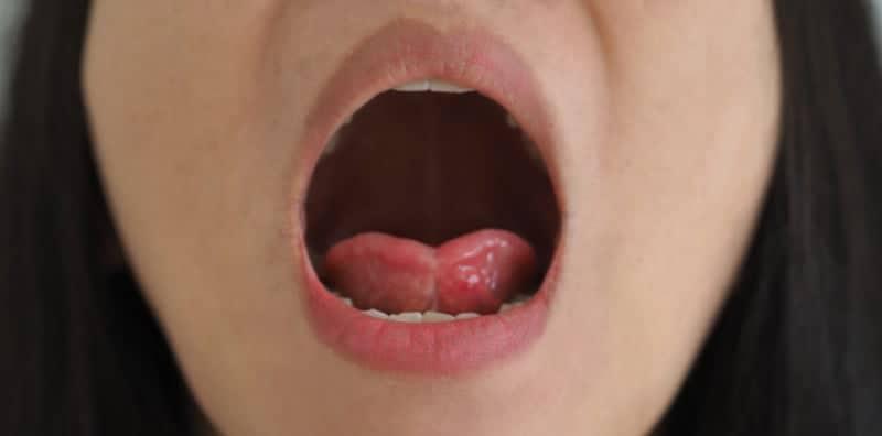 5 Punca Mulut Anda Berdarah Secara Tiba-Tiba Selain Tergigit Lidah Sendiri!