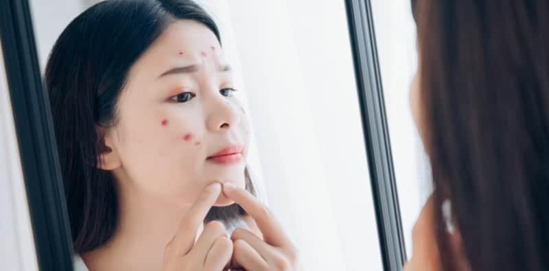 Ini Dia Cara Kecutkan Jerawat Bengkak, Jangan Picit-picit Lagi Ya!