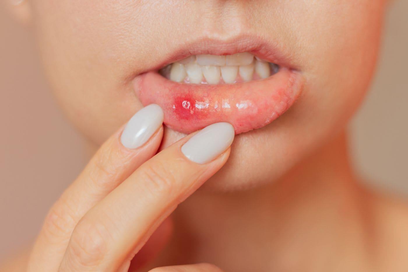 cara-hilangkan-ulser-di-bibir