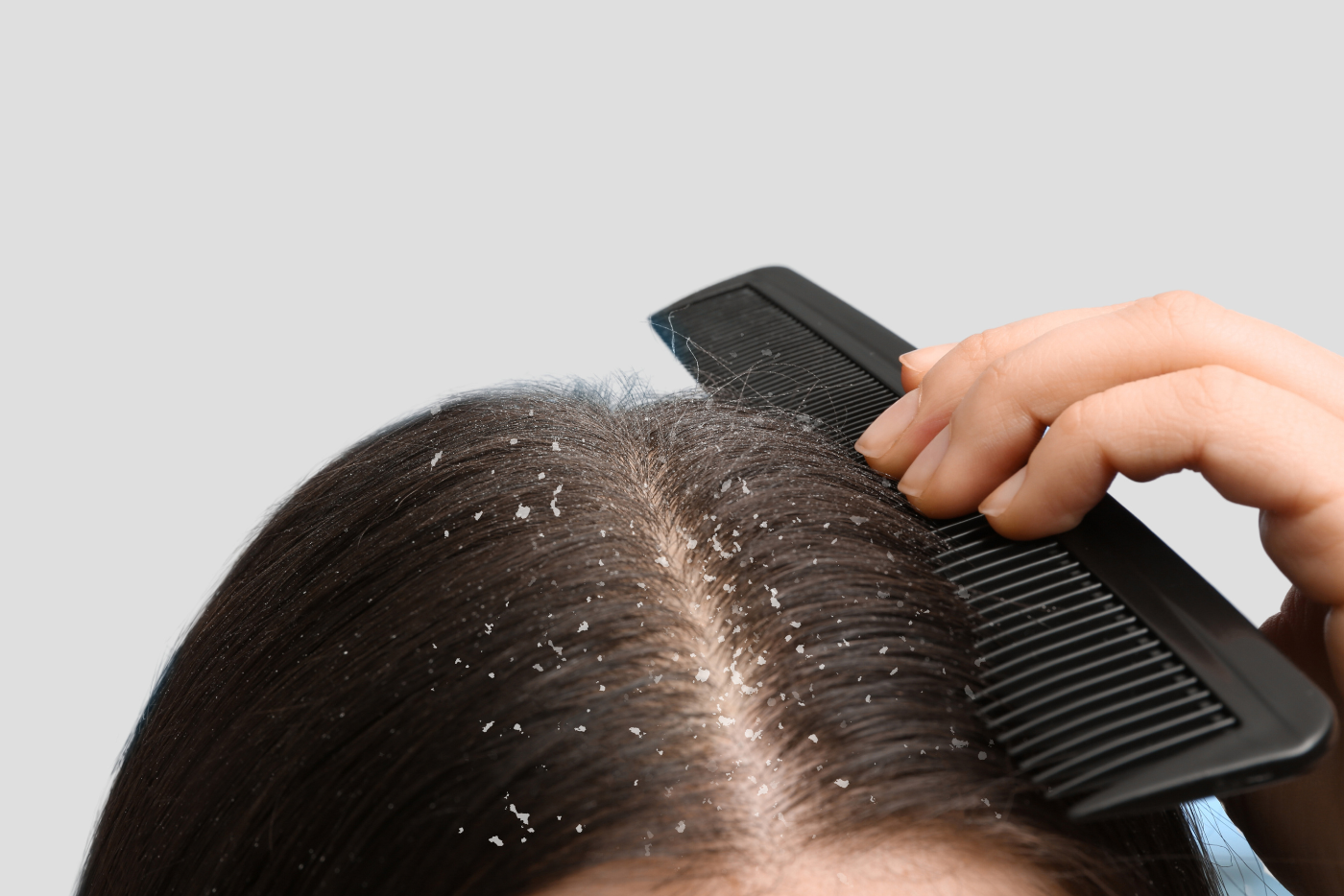 Kelemumur Teruk Sangat Sampai Kepala Berbau? Ini 3 Cara Berkesan Hilangkan Ketombe