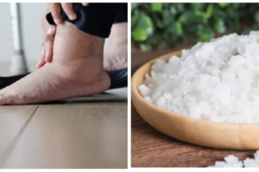 5 Petua Hilangkan Bengkak Kaki Kencing Manis, Antaranya Guna Garam Ini!