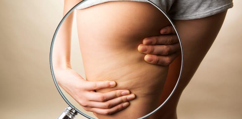 9 Punca Anda Ada Selulit Paha Berserta 5 Cara Cepat Untuk Hilangkannya