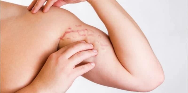 Selulit Merah Boleh Pudar Dengan 4 Terapi + 4 Cara Ini, Barulah Kulit Mulus!