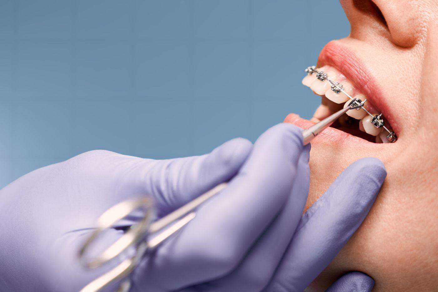 Tak Yakin Nak Senyum Sebab Gigi Jarang? Ini 5 Rawatan Anda Boleh Cuba!