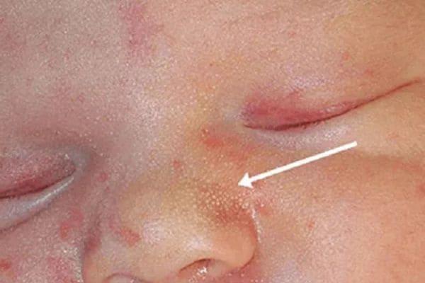 cara hilangkan ruam di muka bayi