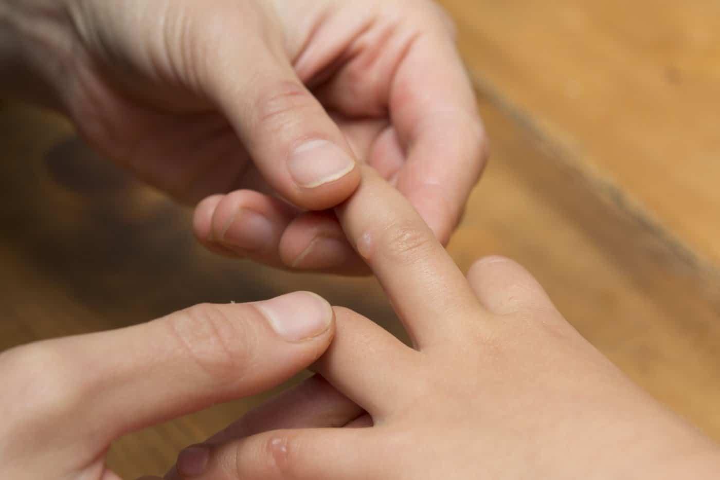 Anak Dijangkiti Penyakit Tangan Kaki Dan Mulut, Ikut Tip Ini Cegah & Jaga Anak HFMD