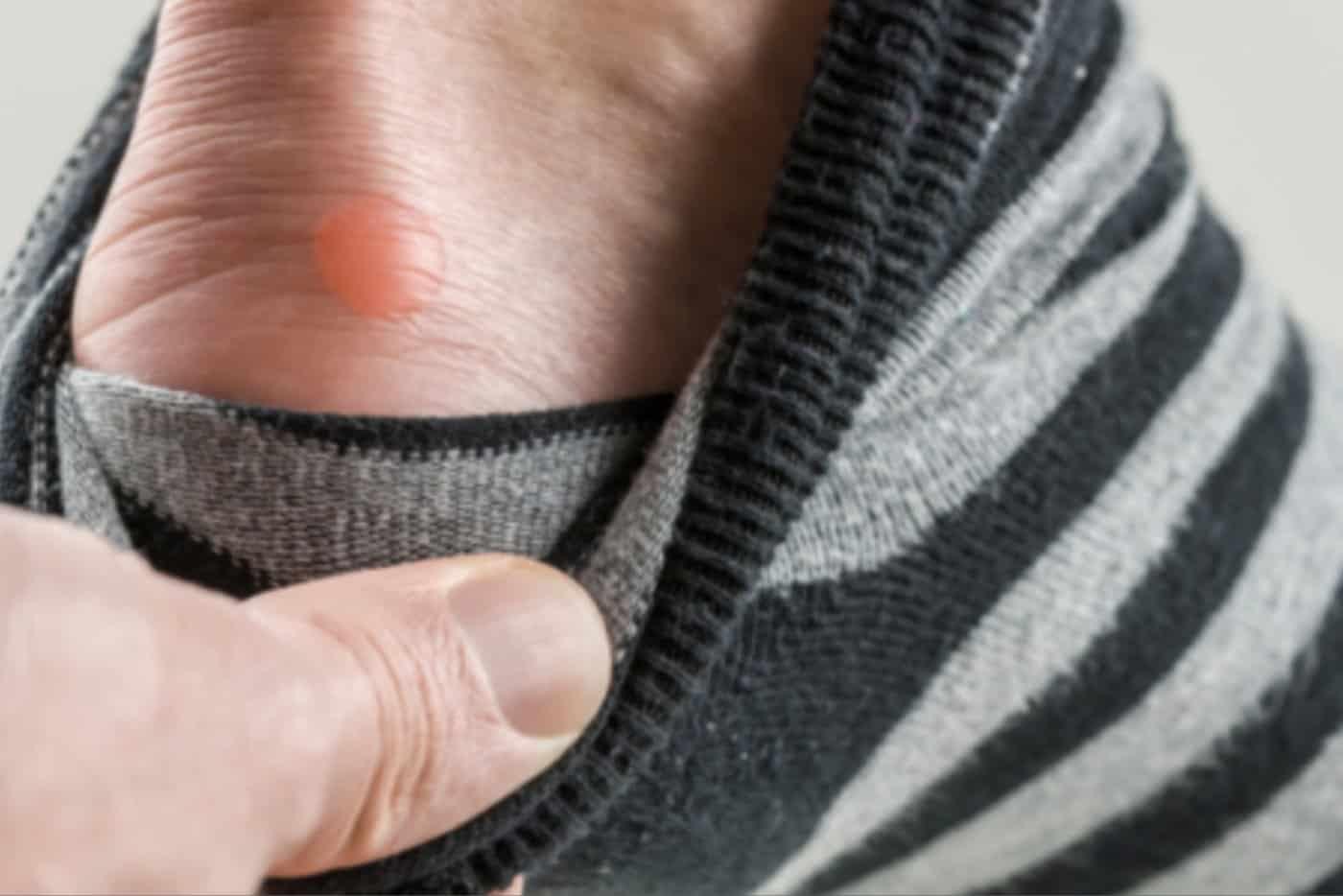 Aduh, Sakitnya Ada Gelembung Air Di Kaki! Cuba Rawat Dengan 13 Tip Ini