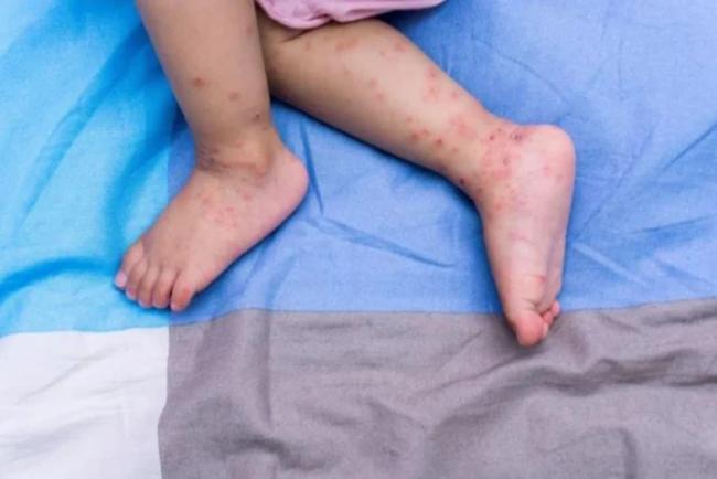 FAQ: Pakar Pediatrik Jawab Soalan Lazim Tanda HFMD & Tip Penjagaan Anak