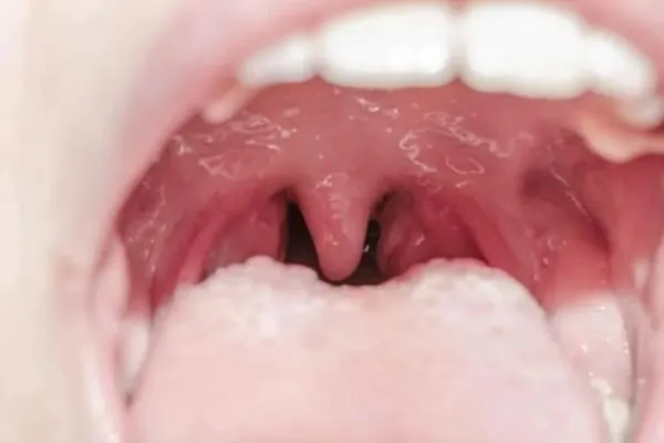 ubat tonsil bengkak
