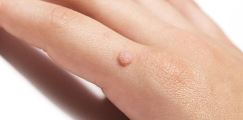 8 Cara Moden & Tradisional Ini Boleh Hilangkan Ketuat Pada Kulit, Jom Cuba Buang Sekarang!