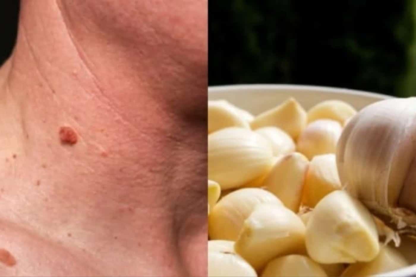 Rimas Tengok Ketuat Pada Badan? Ini Cara Nak Buang, Hanya Perlu Buat Di Rumah!