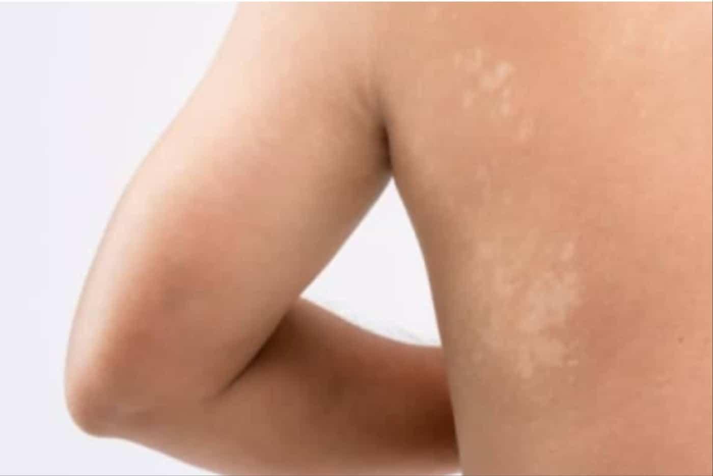 Kulit Bertompok Putih Sebab Panau? Ini 7 Ubat Paling Berkesan Untuk Rawat Cepat!