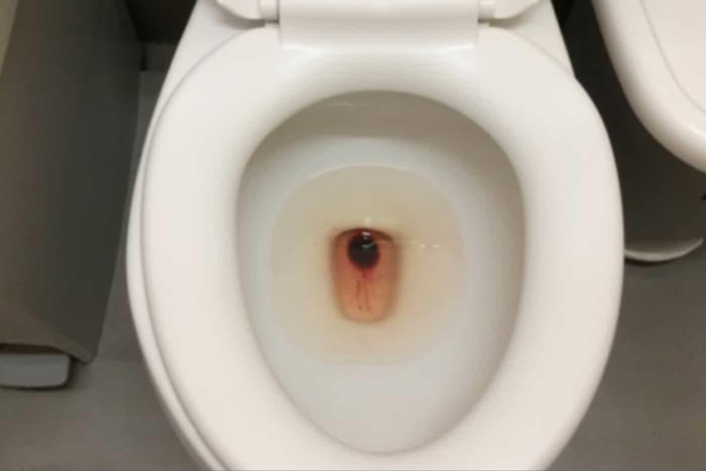 17 Punca Darah Dalam Air Kencing! Berbeza Ikut Lelaki, Perempuan, Kanak-Kanak & Ibu Hamil!