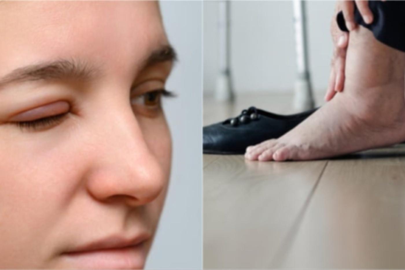 Muka, Kaki Membengkak! Selain Itu, Ada 6 Lagi Tanda Buah Pinggang Anda Mula Rosak!