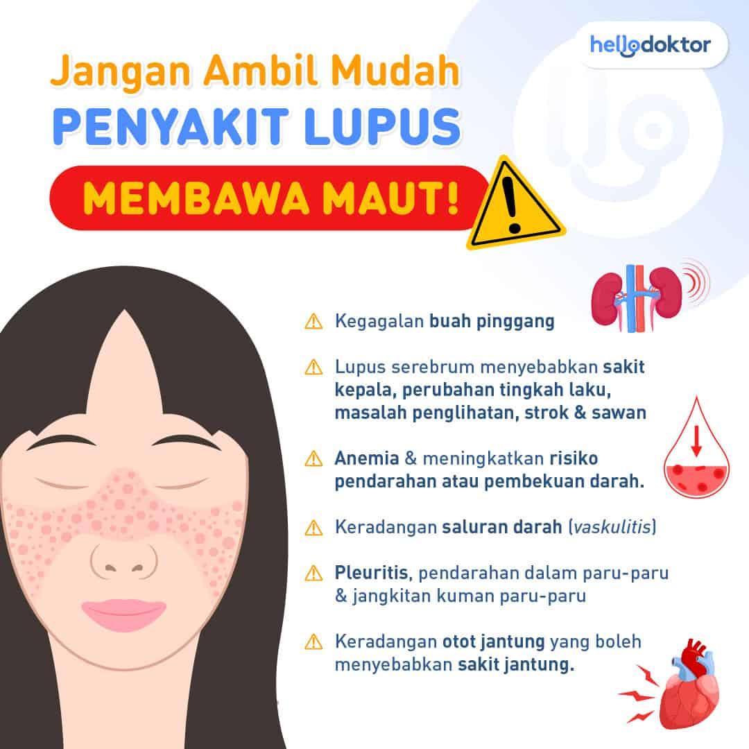 penyakit SLE