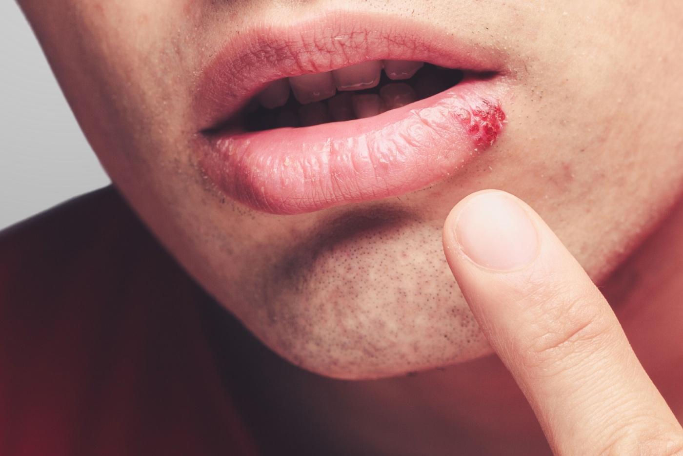 Tanda Jangkitan HIV Lelaki Pada Seluruh Tubuh Badan, Bukan Alat Sulit Sahaja!