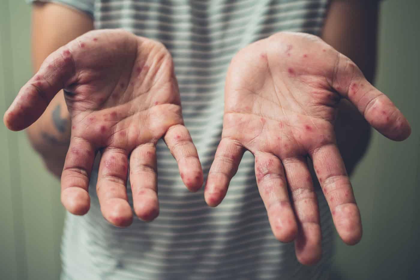 Bolehkah Orang Dewasa Hidap HFMD? Ini Simptom Yang Perlu Diperhatikan!