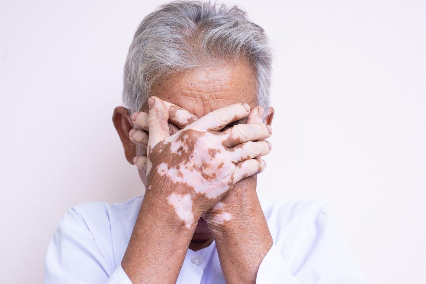 Kondisi Vitiligo @ Sopak, Bolehkah Ia Berlaku Ketika Individu Itu Sudah Berusia?