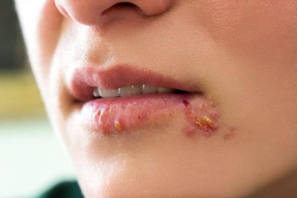 punca herpes bibir