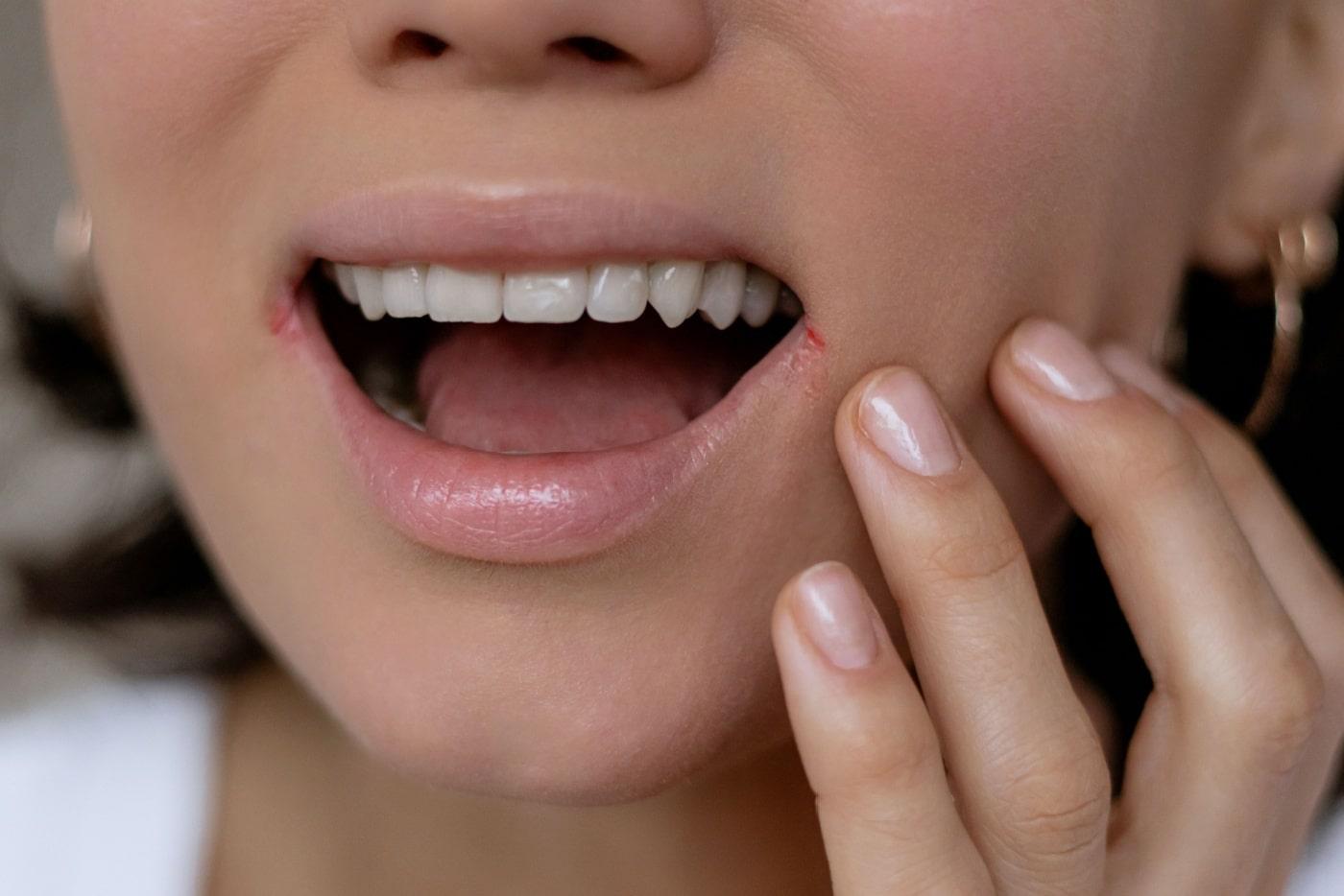 Herpes Bibir Bukan Main-Main, Ini Punca Sebenar & Cara Elak Berjangkit