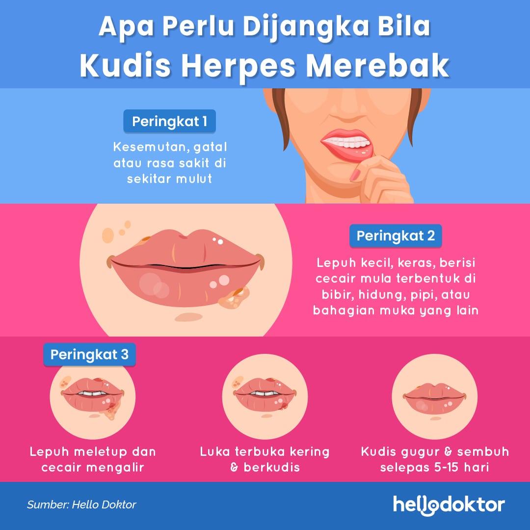 punca herpes bibir