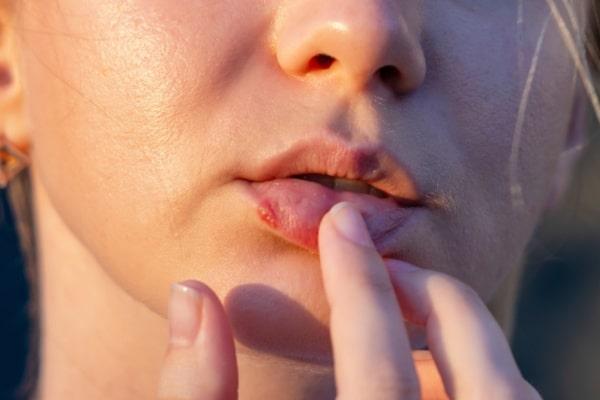 punca herpes bibir