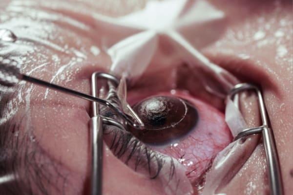 lasik mata