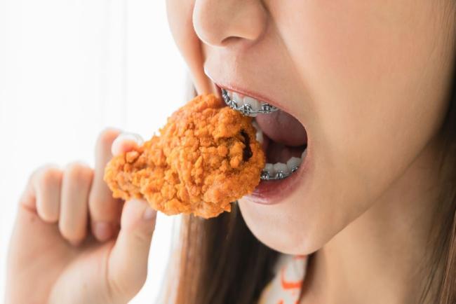 AWAS, Makanan Biasa Tapi Boleh Buat Braces Tercabut! Jangan Langgar Pantang Ini Ya!
