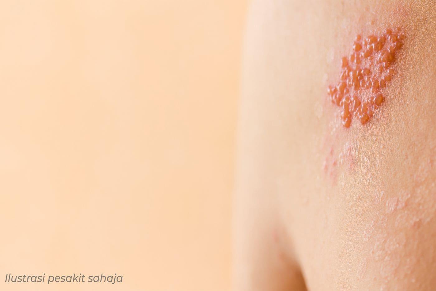 risiko-penyebab-kayap-penyakit-kronik