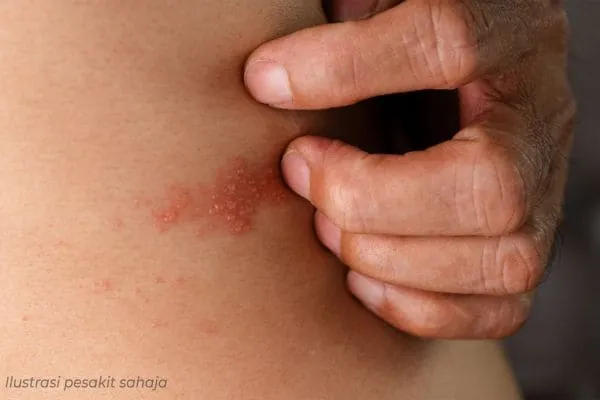 risiko penyebab kayap