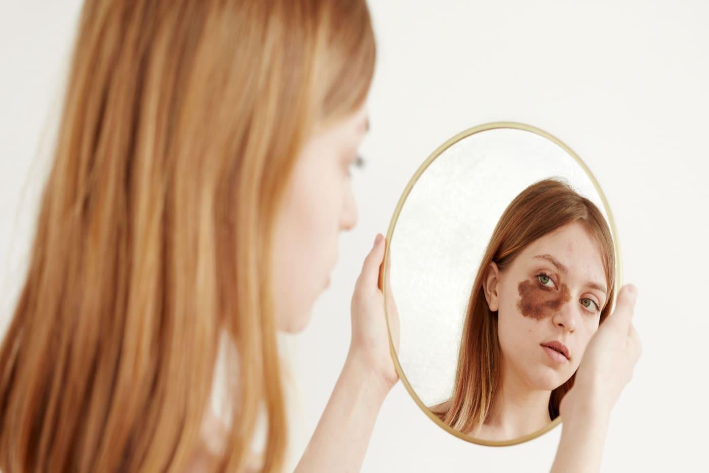 Nak Buang Tanda Lahir Di Wajah? Ini Yang Perlu Anda Tahu Sebelum Mula Rawatan